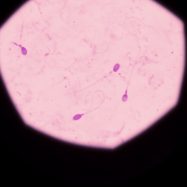 What is azoospermia in males?